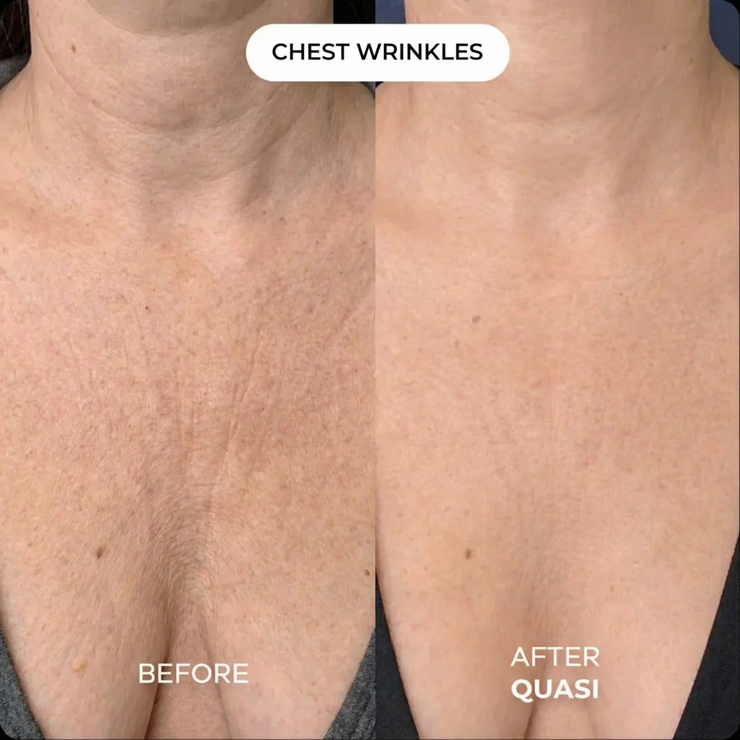 Collagen Chest Mask